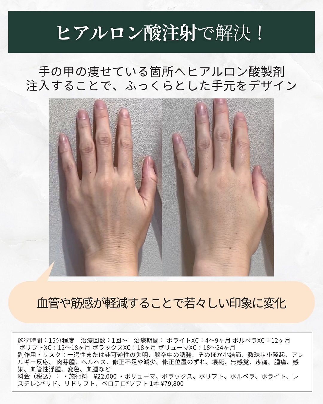 ヒアルロン酸を手の甲に打ったときの変化