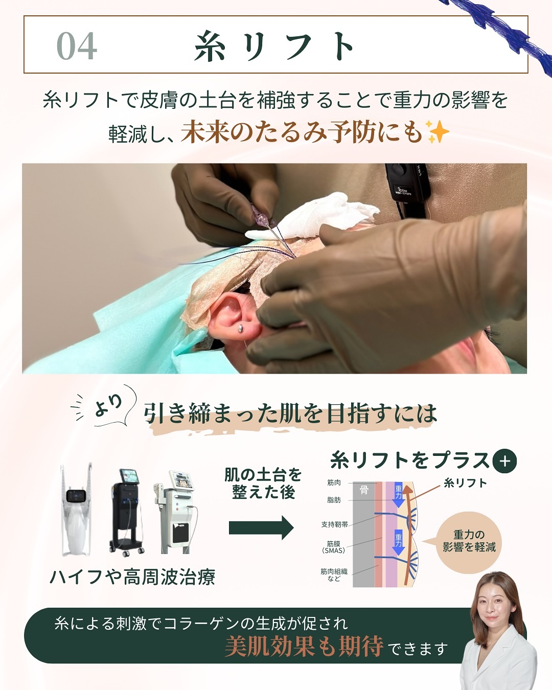 糸リフト