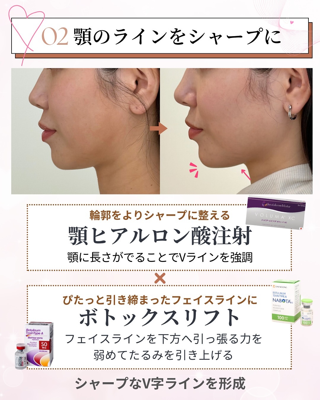 顎のラインをシャープに