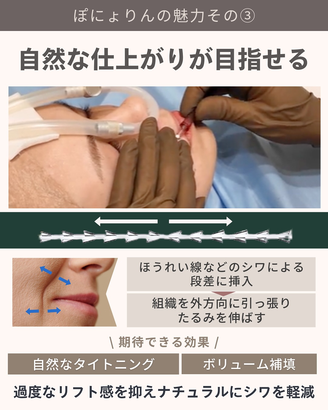 ぽにょりん 自然な仕上がり