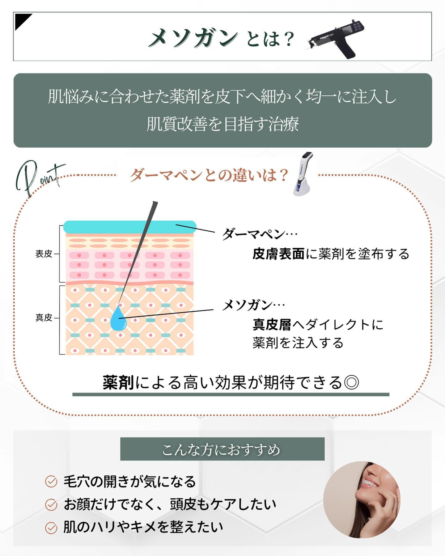針の美容施術 メソガン