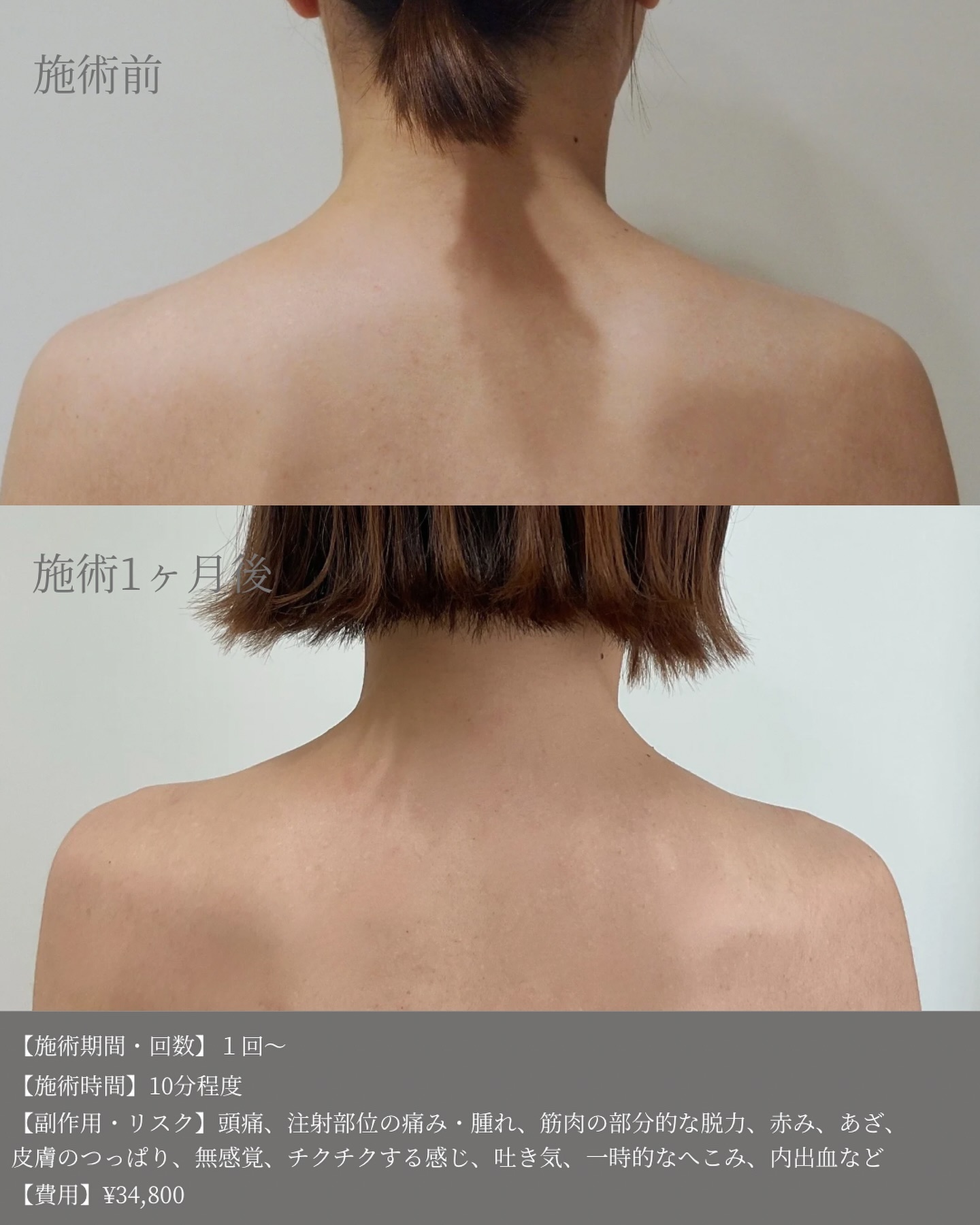 肩ボトックスのビフォーアフター