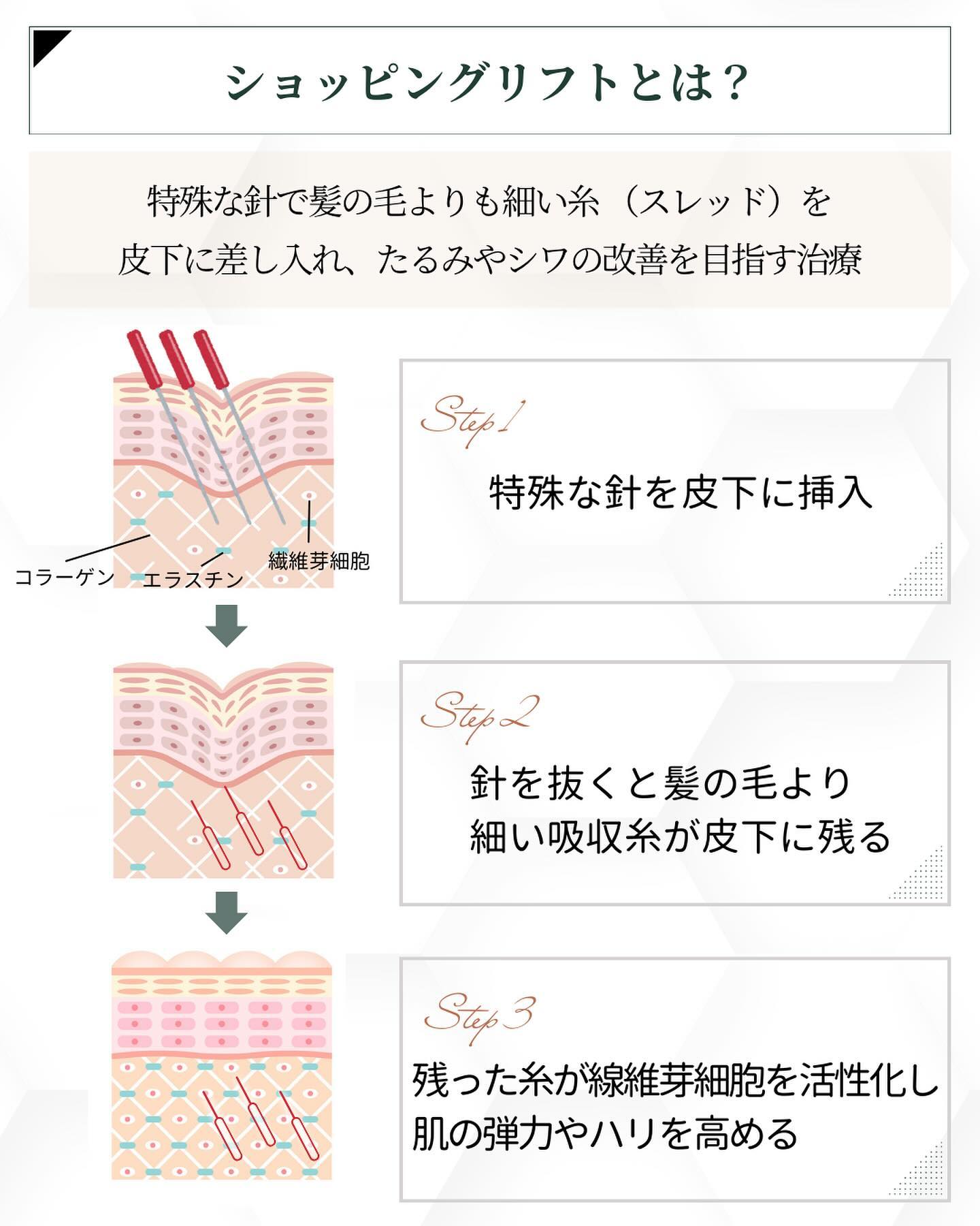 ショッピングリフトの仕組み