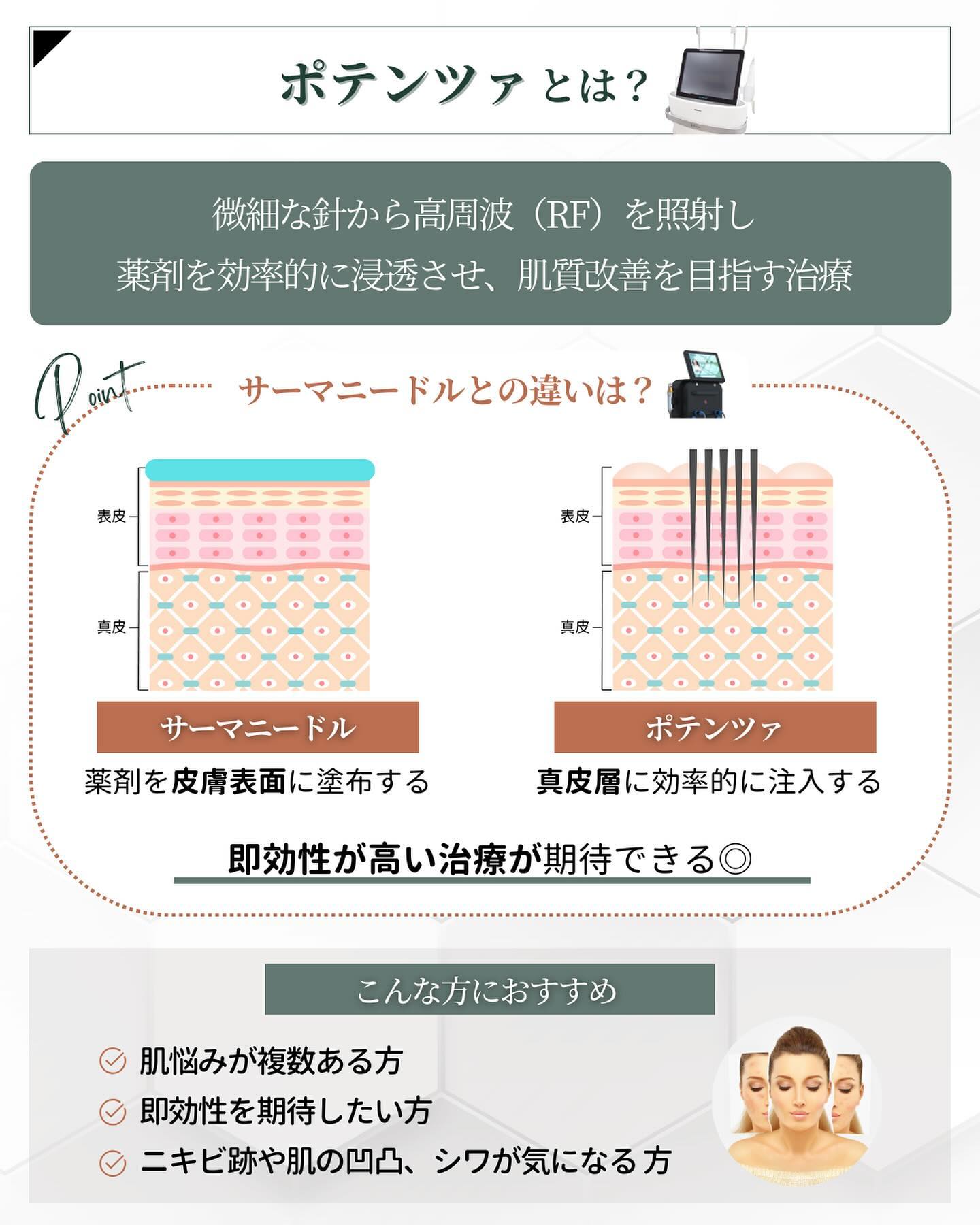 針の美容施術 ポテンツァ