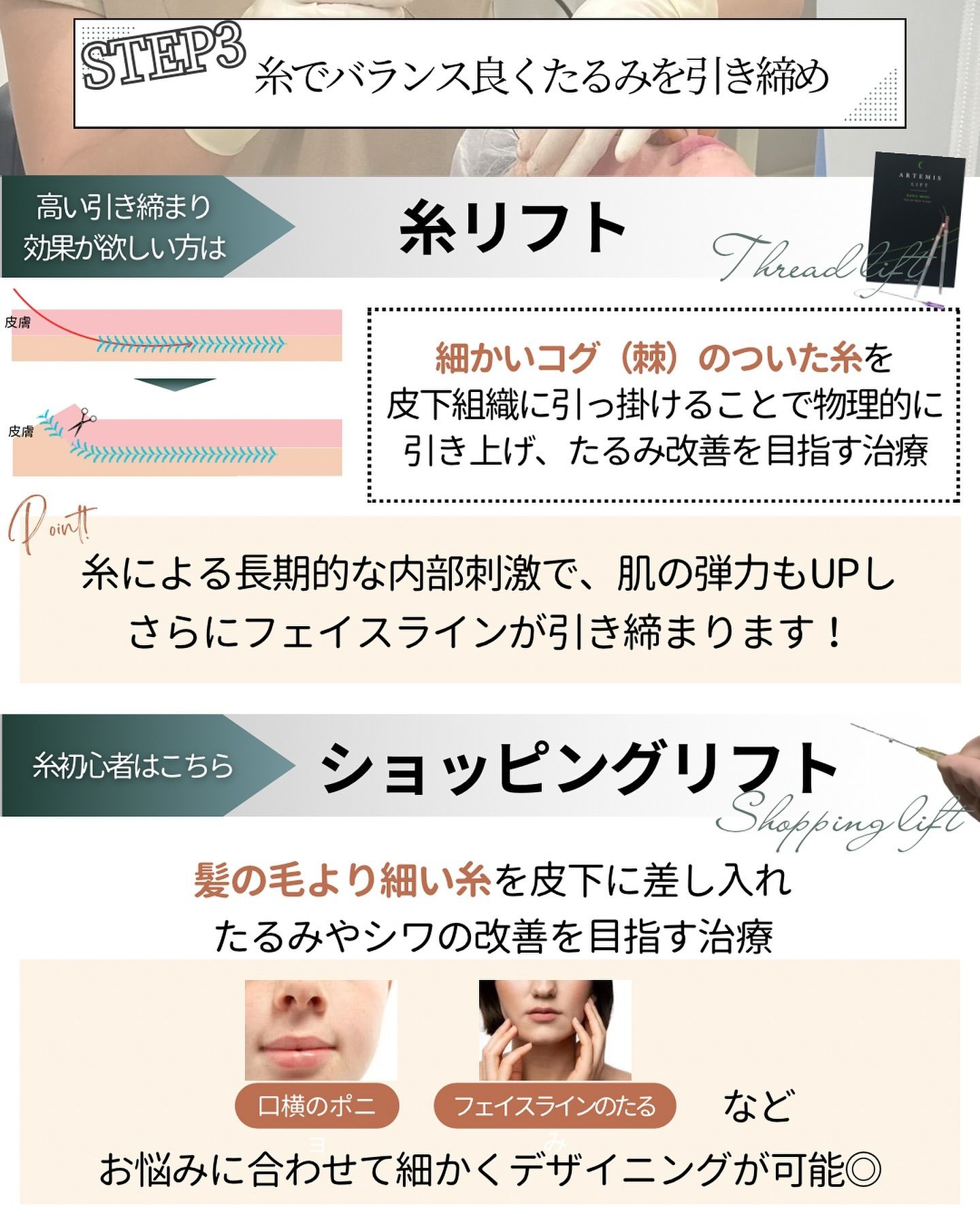 ショッピングリフトor糸リフト