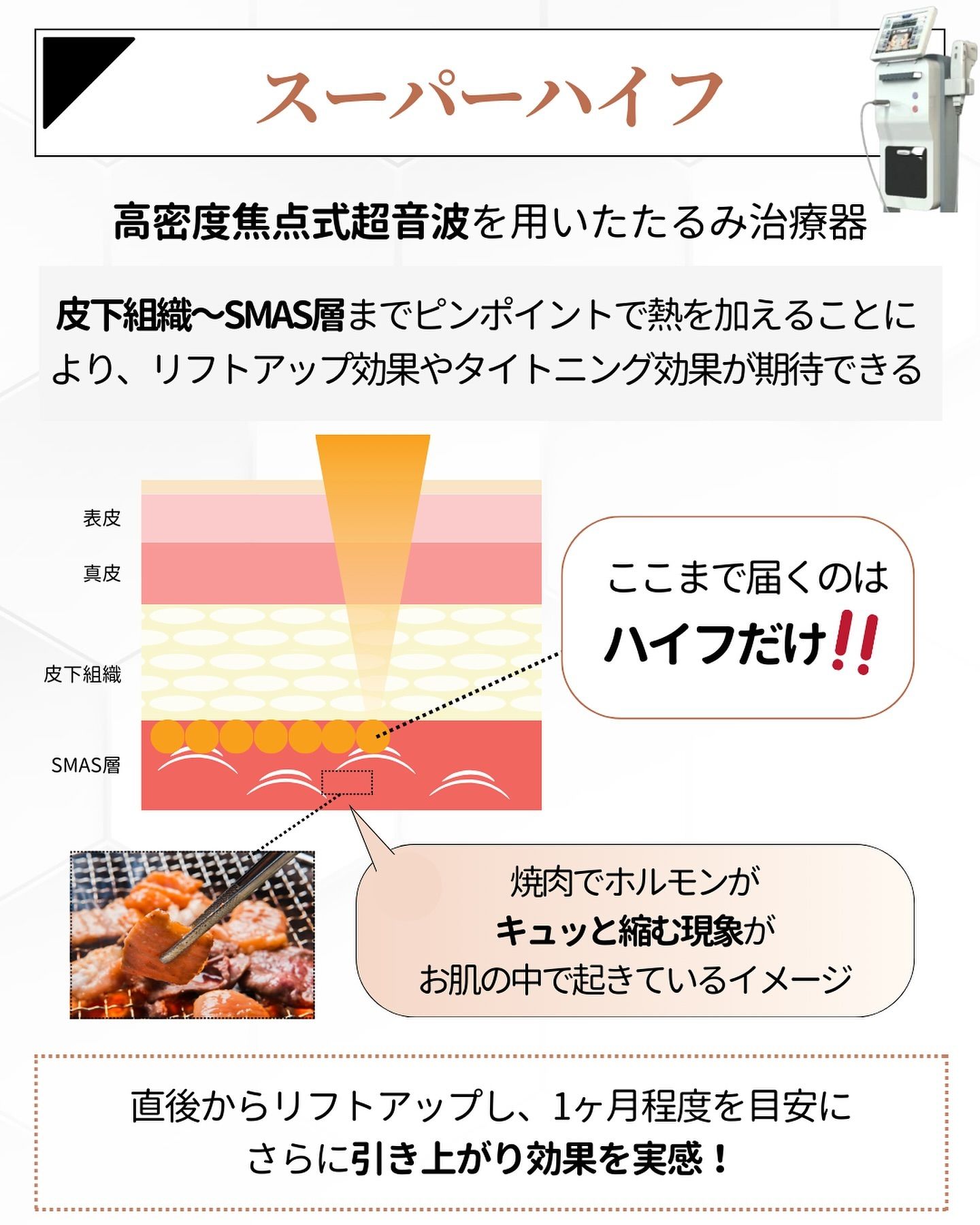 ハイフの効果とリフトアップ効果の詳細