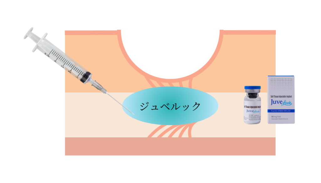 ジュベルックを広島で受けるなら|特徴や施術の流れを解説