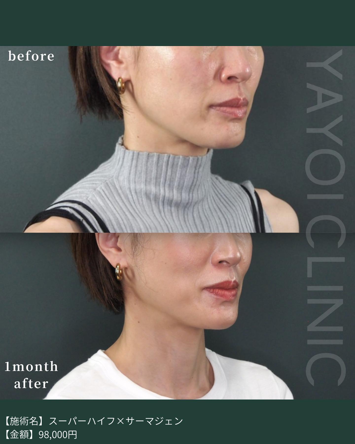 YAYOICLINIC ハイフ サーマジェン