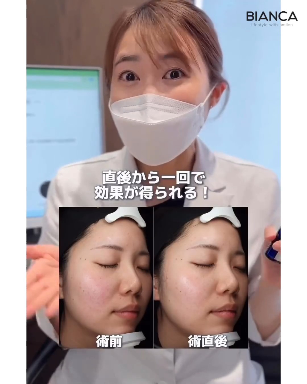 メソナSAまとめ