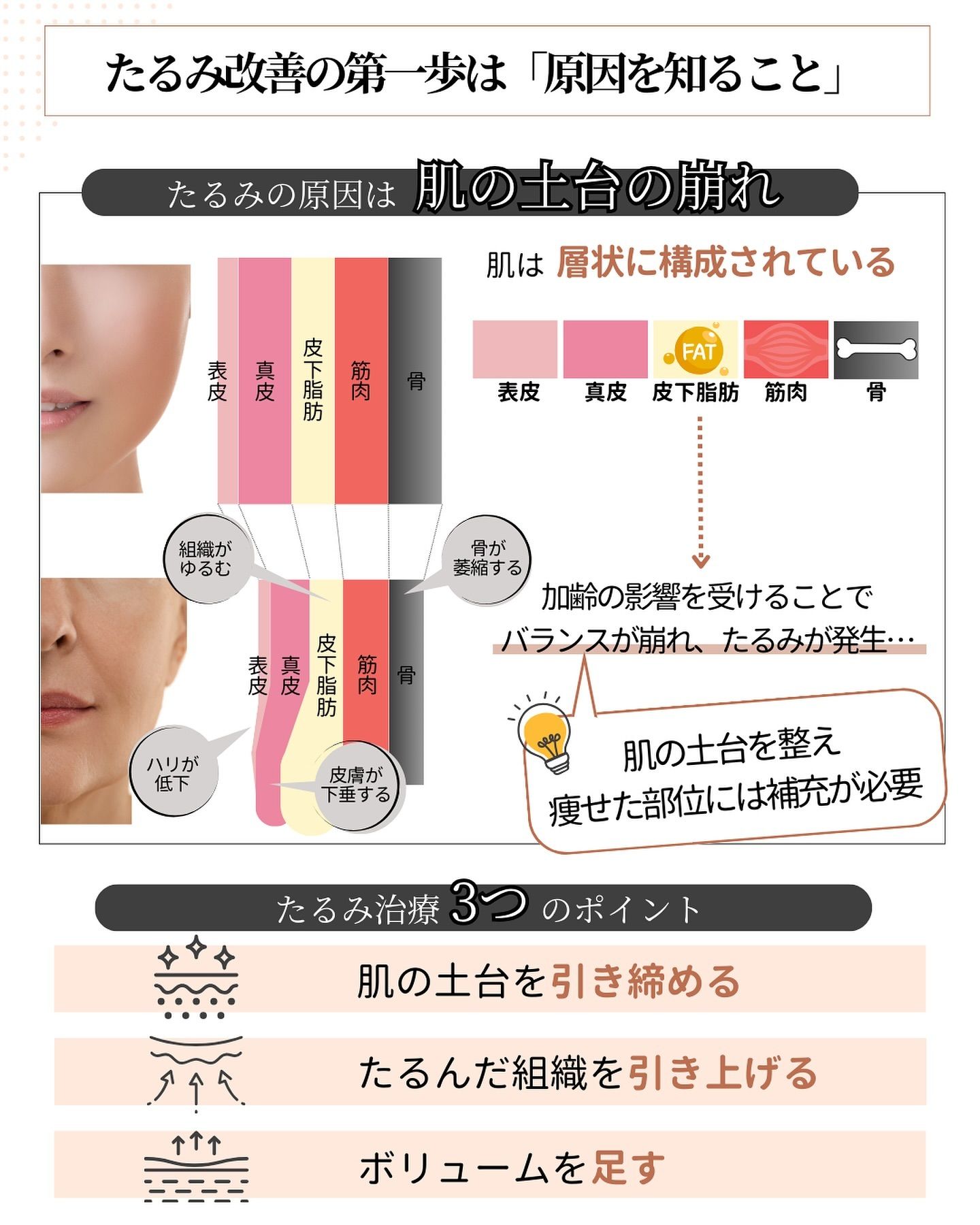 たるみの原因と3つの施術ポイント