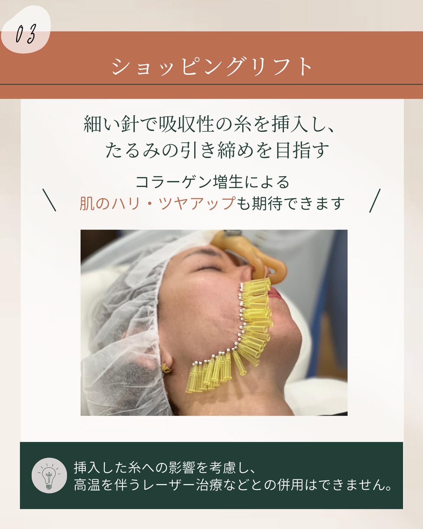 たるみ治療(ショッピングリフト)