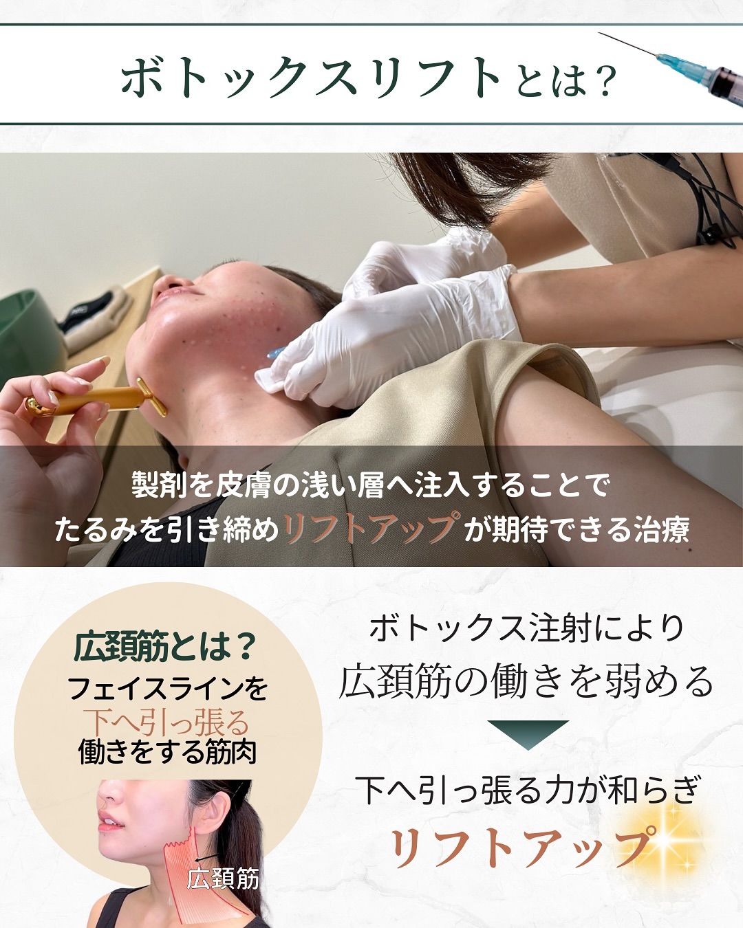 ボトックスリフトとは 効果