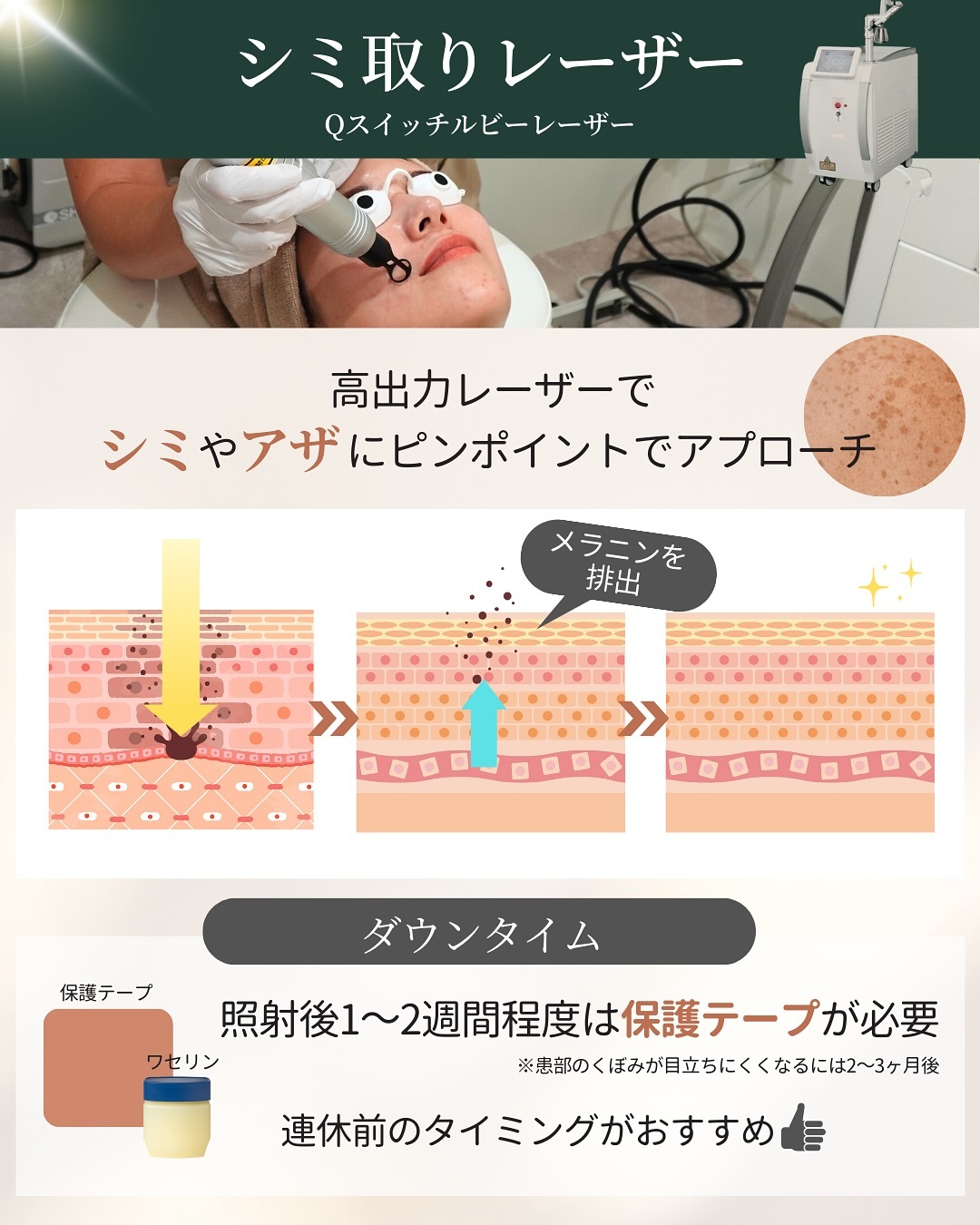 Qスイッチルビーレーザーの仕組みとダウンタイム