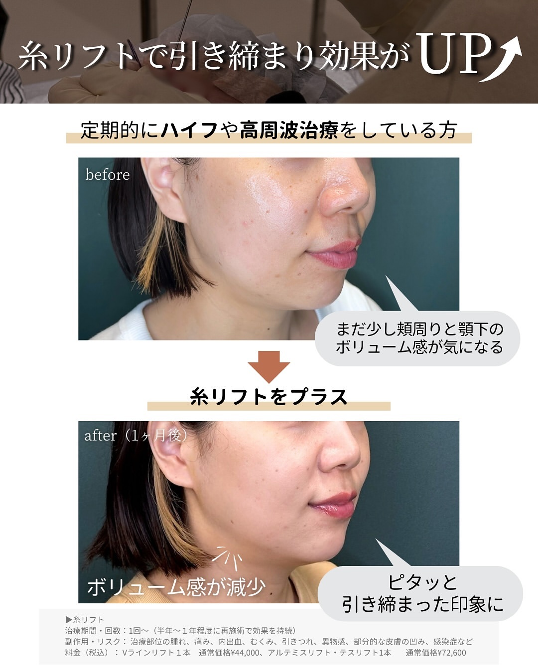 糸リフトで引き締まり効果がUP