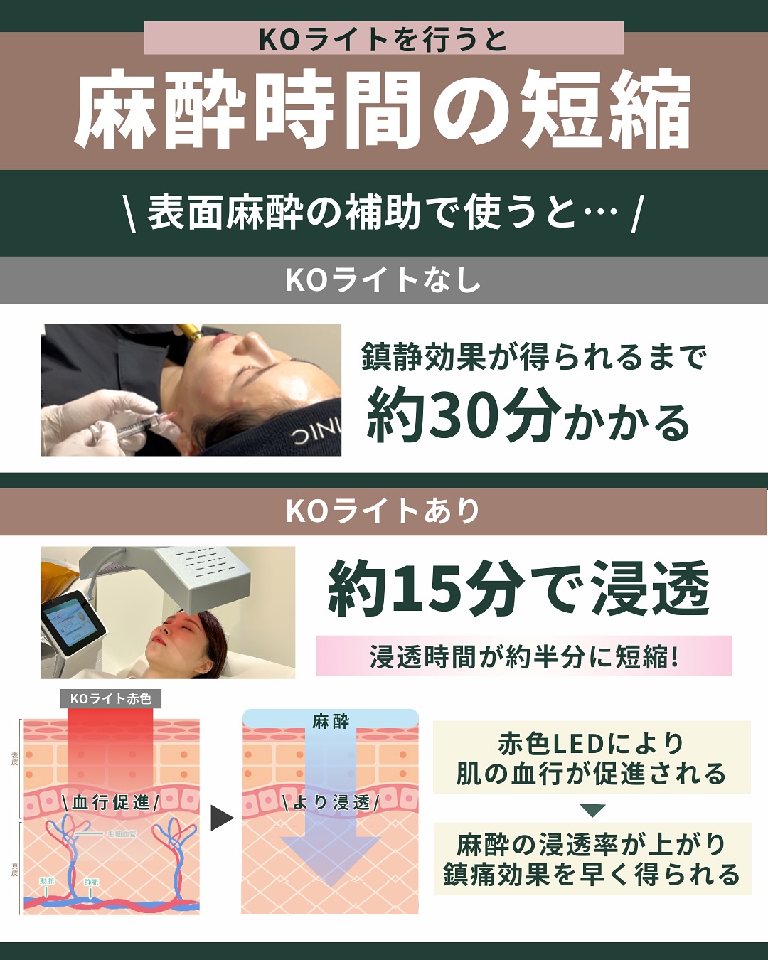 KOライトで麻酔時間の短縮