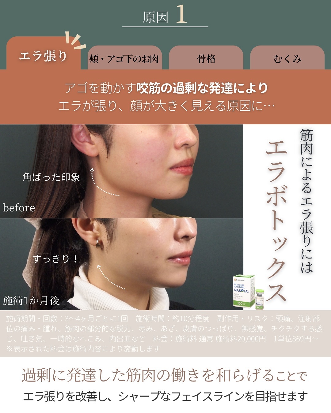 筋肉によるエラ張りに適したエラボトックス