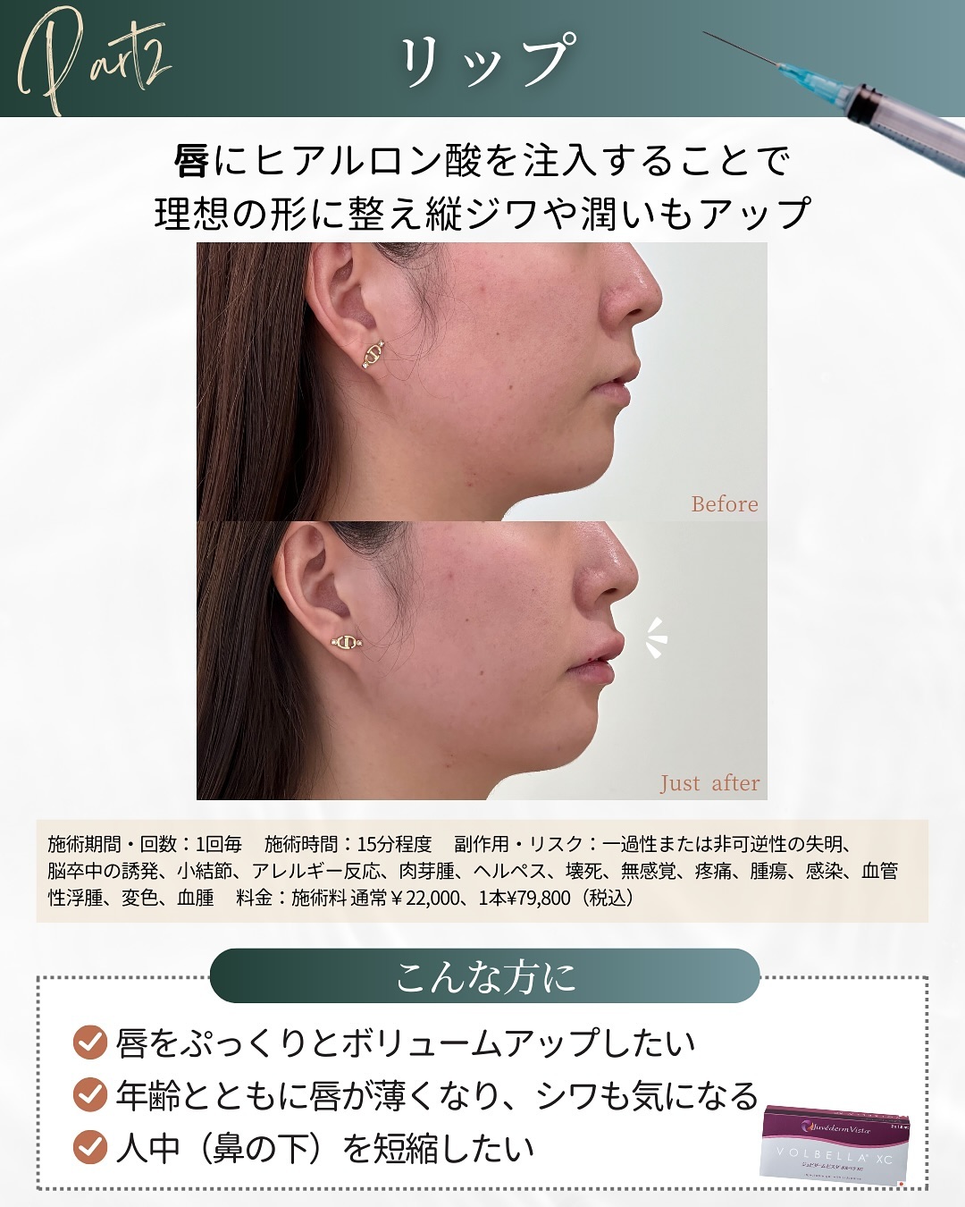 ヒアルロン酸注入の施術部位 リップ