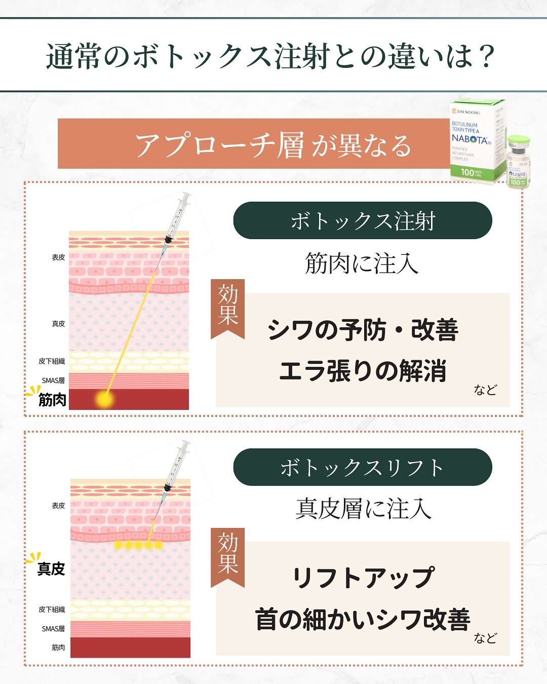 ボトックスリフトとボトックス注射の違い