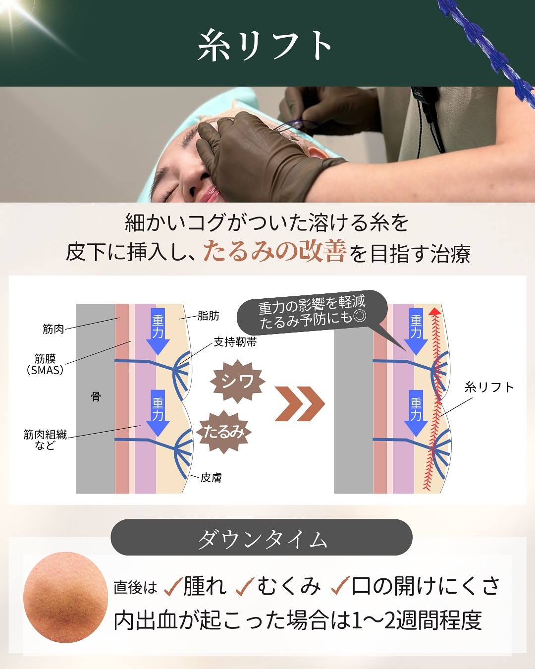 糸リフトの仕組みとダウンタイム