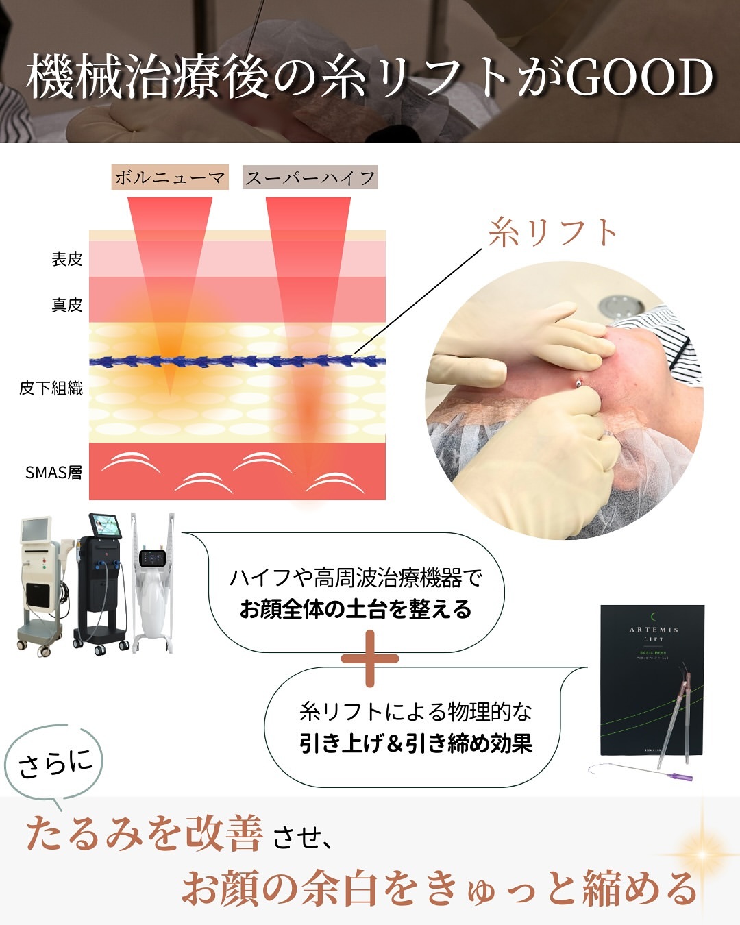 ハイフや高周波治療後の糸リフトで引き上げ＆引き締め効果