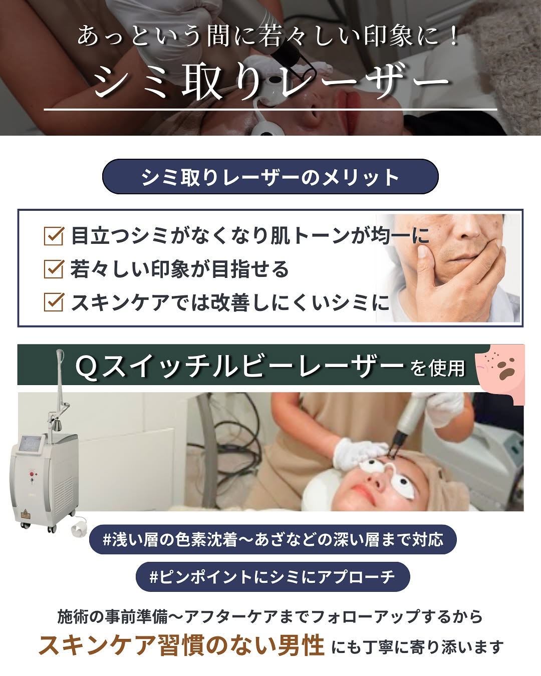 シミ取りレーザー