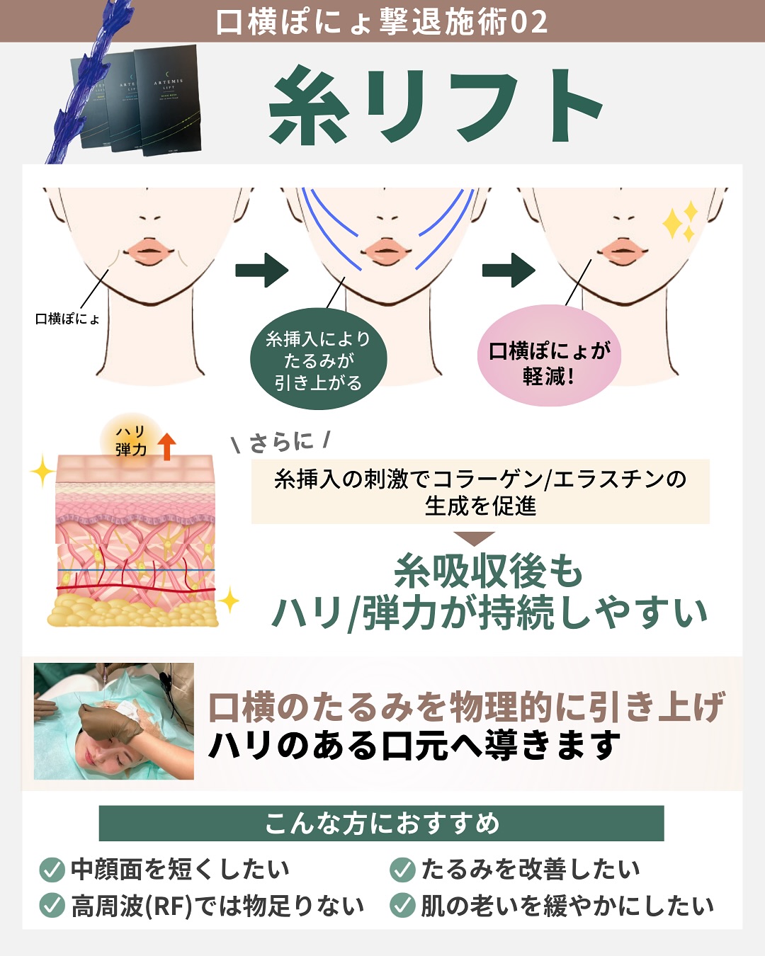 糸リフト たるみの引き上げ