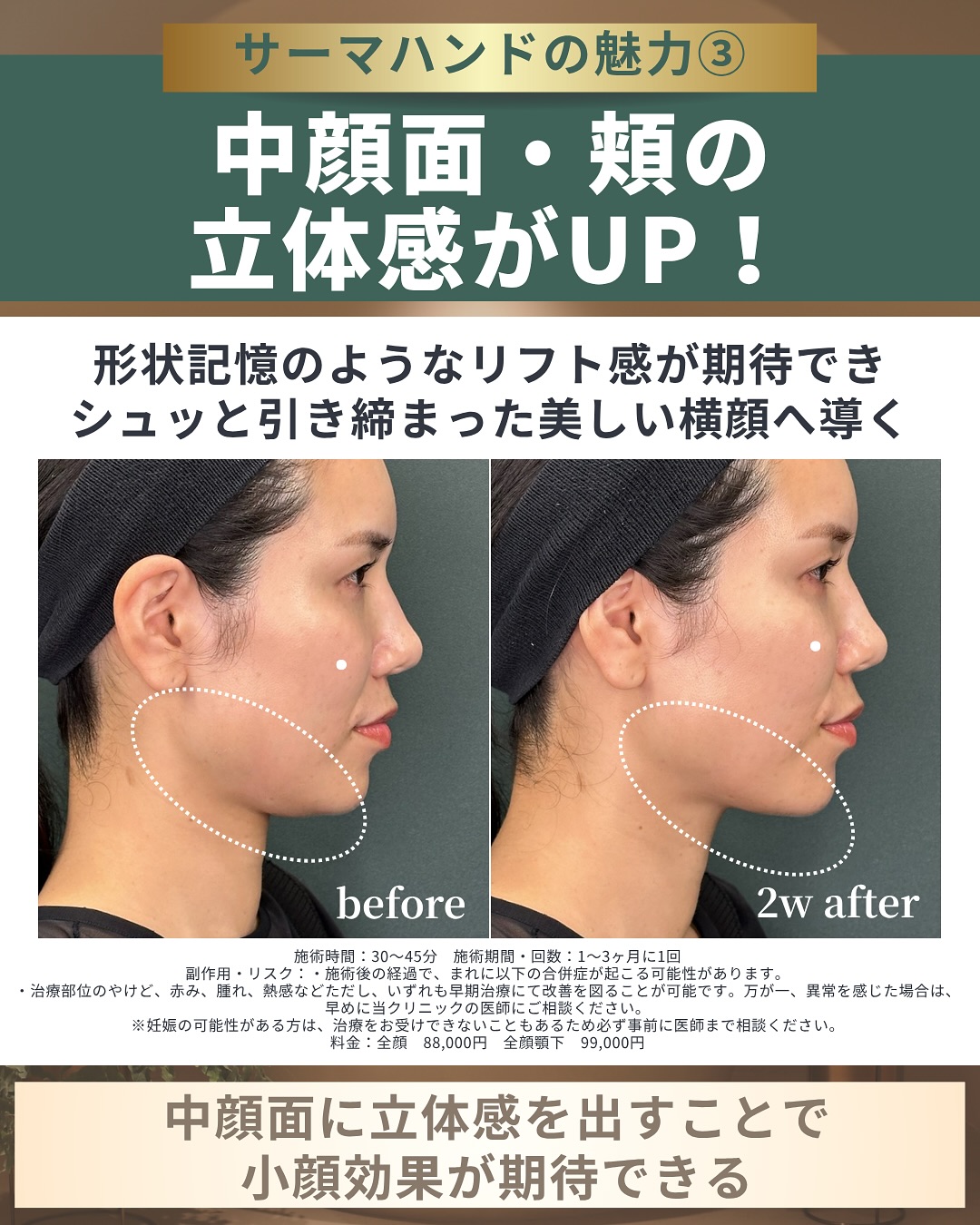 サーマハンド 立体感のある小顔印象へ