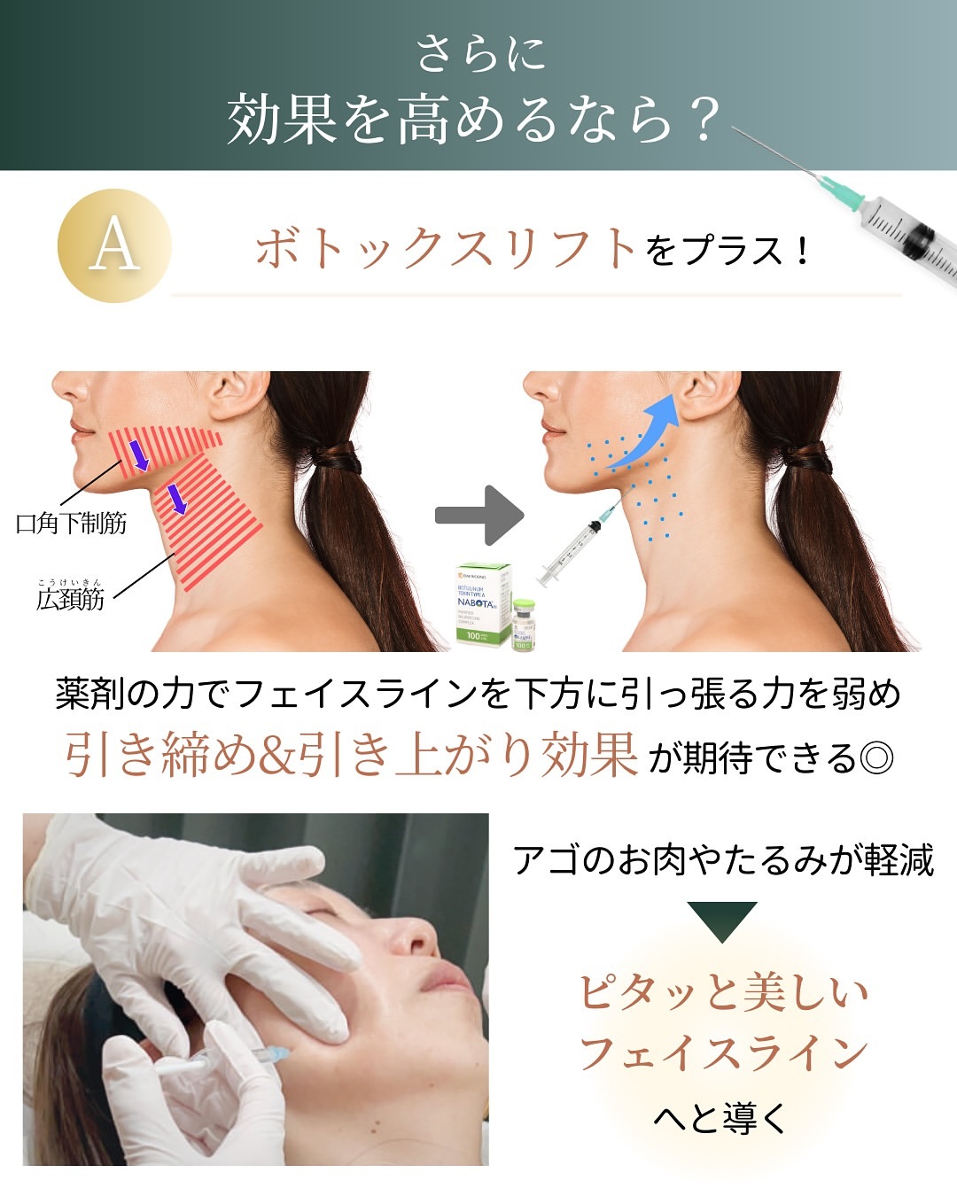 顎のたるみにボトックスリフトもおすすめ