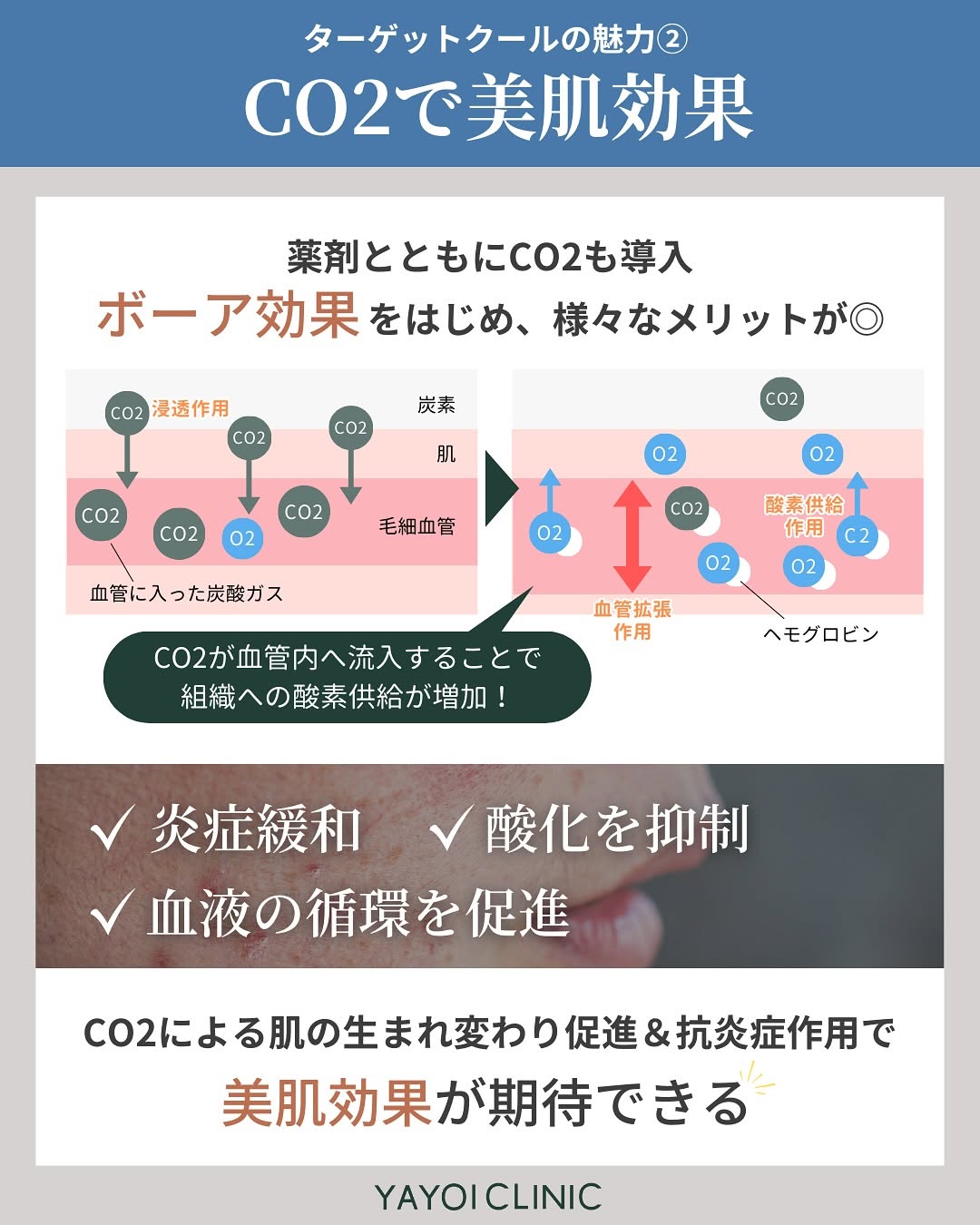 ターゲットクールの魅力2「CO2で美肌効果」