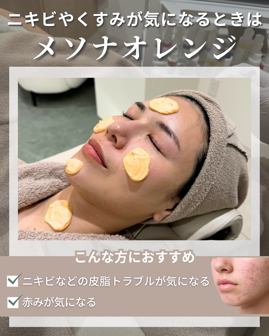 ニキビやくすみが気になるときはメソナオレンジ