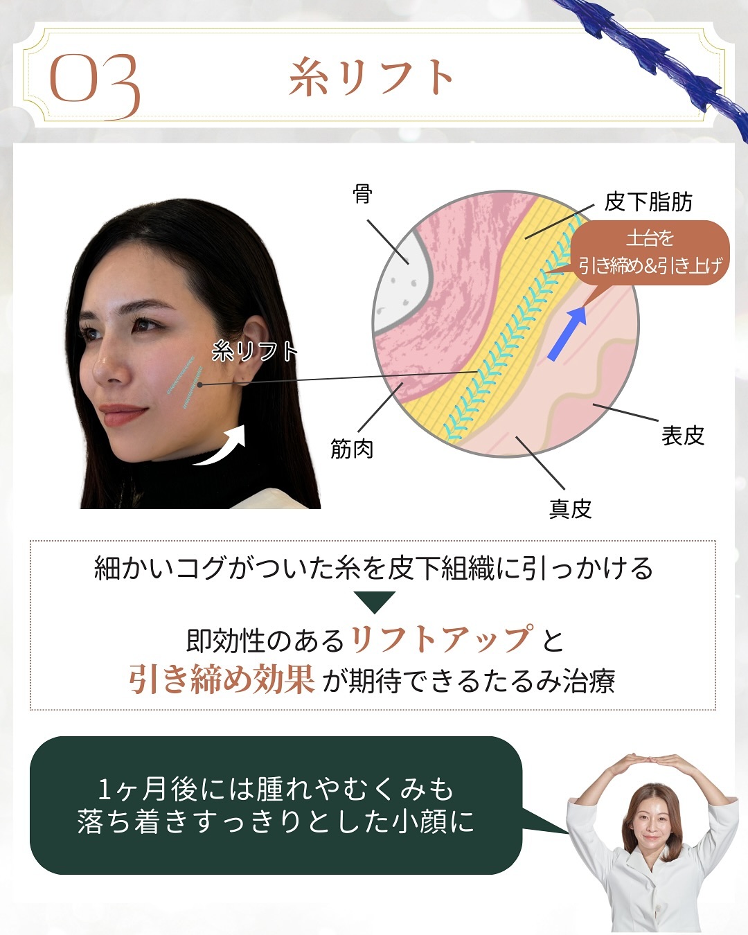 イベント前の美容施術 糸リフト