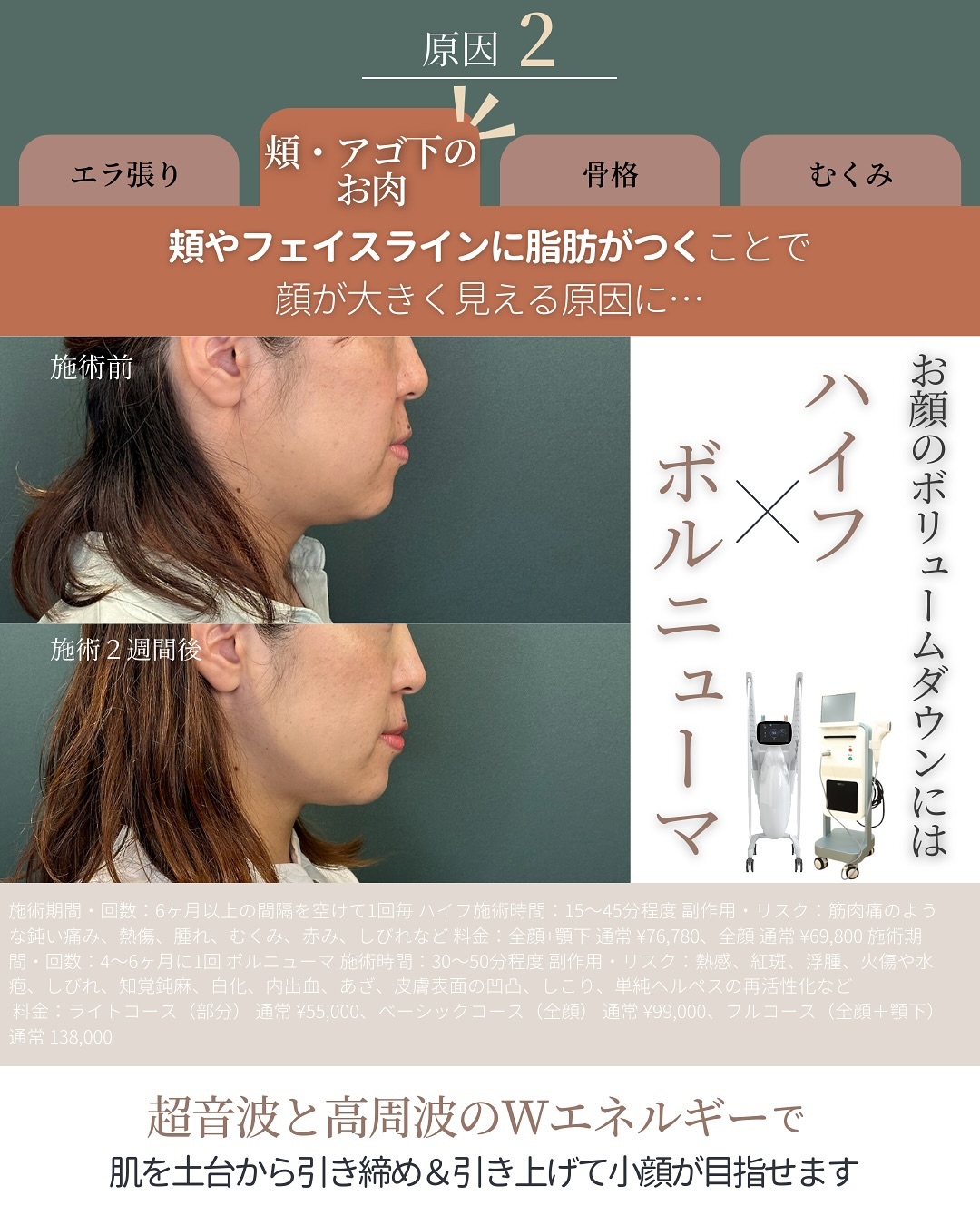 顔のサイズダウンを図るハイフ×ボルニューマ