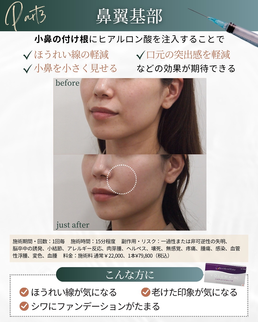 ヒアルロン酸注入の施術部位 鼻翼基部