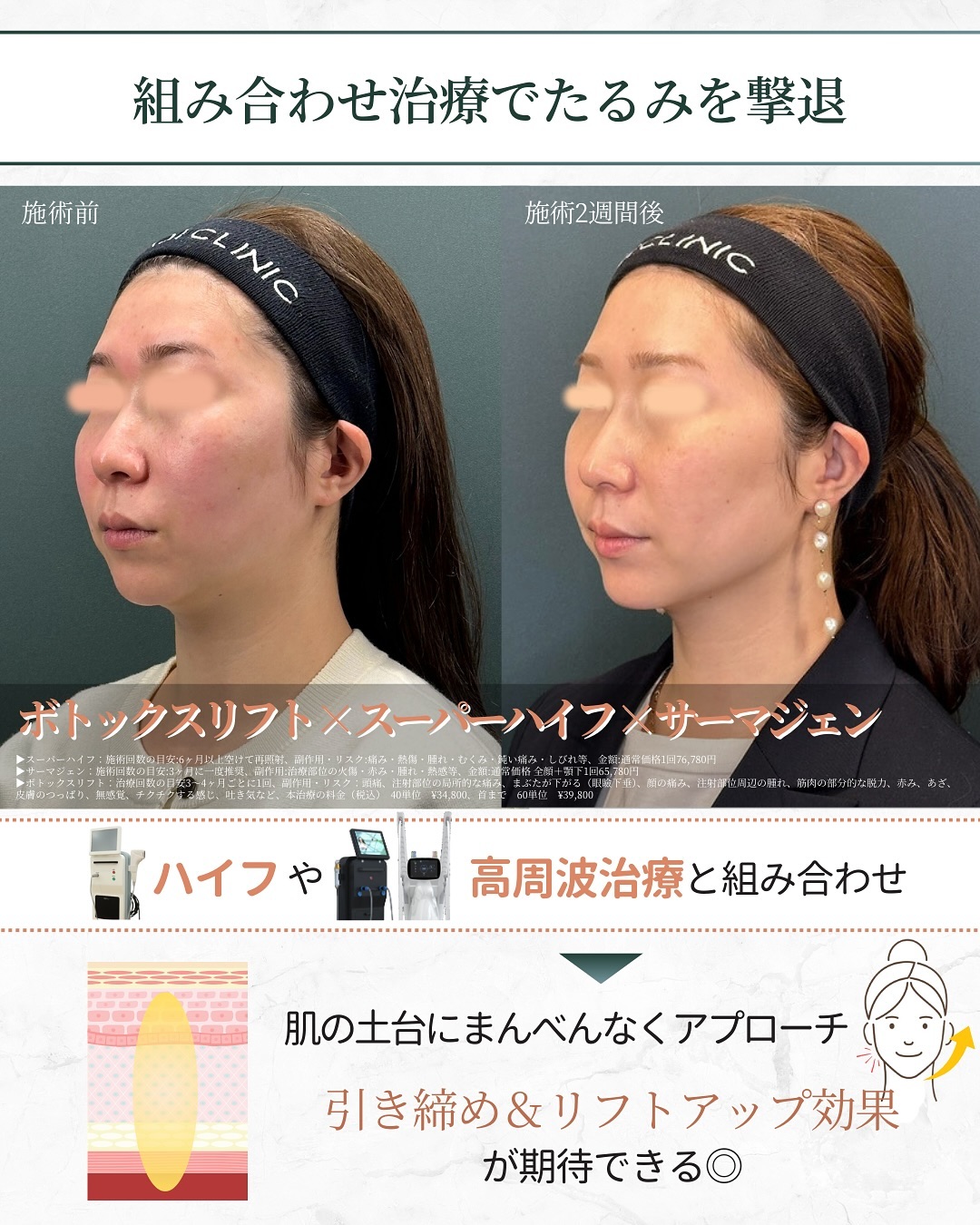 ボトックスリフトの組み合わせ治療