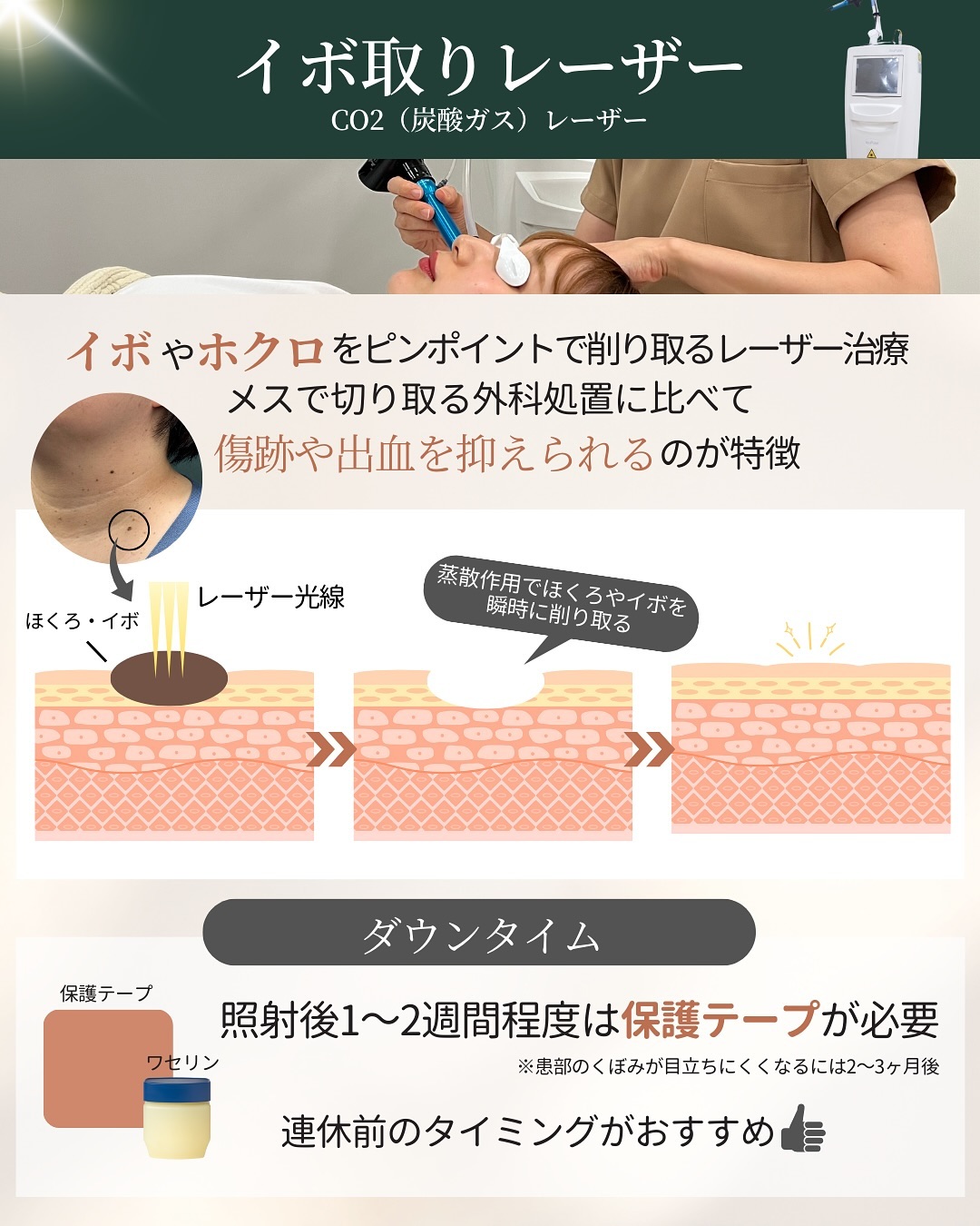 CO2（炭酸ガス）レーザーの仕組みとダウンタイム