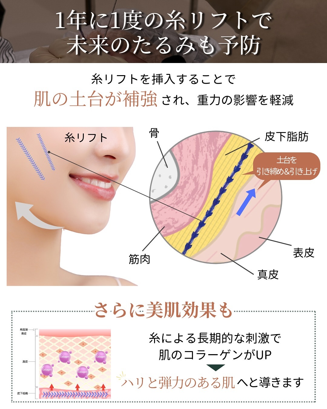 年に1度の糸リフトで未来のたるみを予防