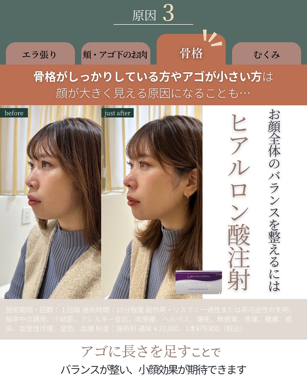 顔全体のバランスを整えるヒアルロン酸注射