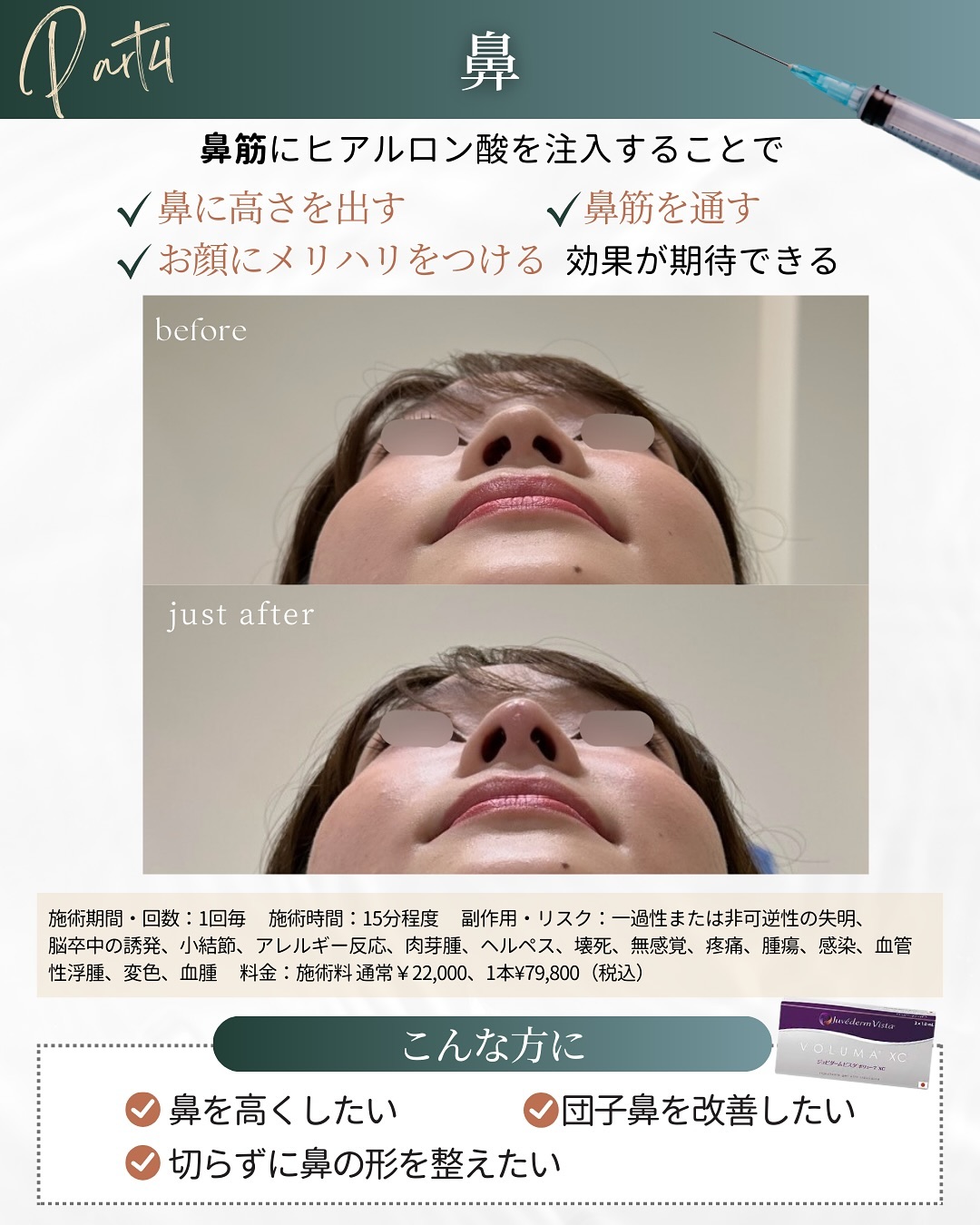 ヒアルロン酸注入の施術部位 鼻