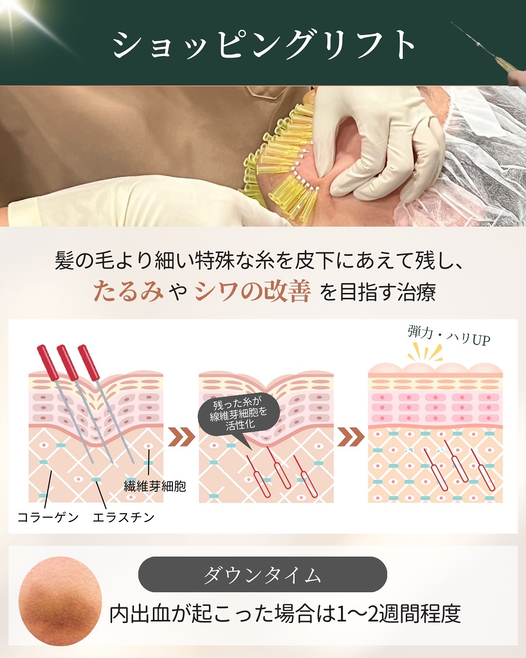 ショッピングリフトの仕組みとダウンタイム