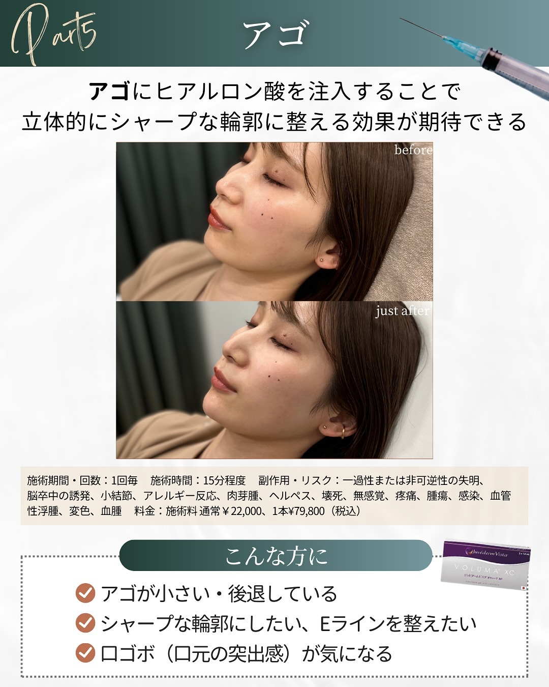 ヒアルロン酸注入の施術部位 アゴ