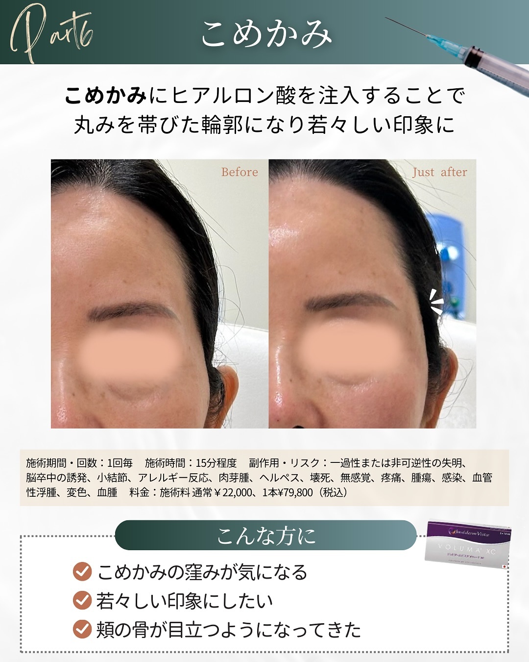 ヒアルロン酸注入の施術部位 こめかみ