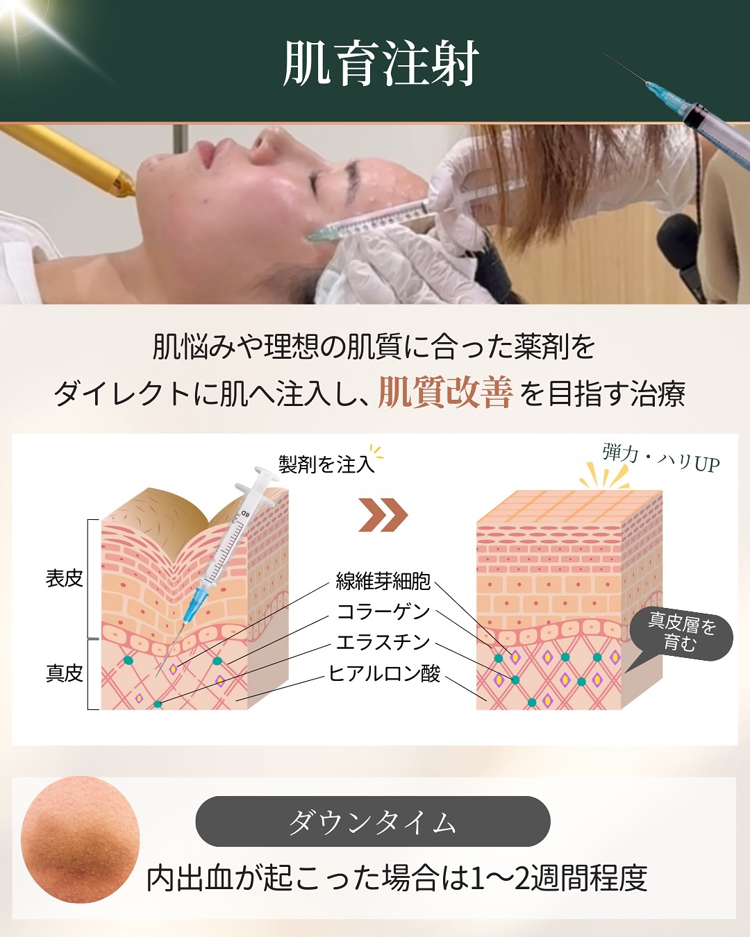 肌育注射の仕組みとダウンタイム