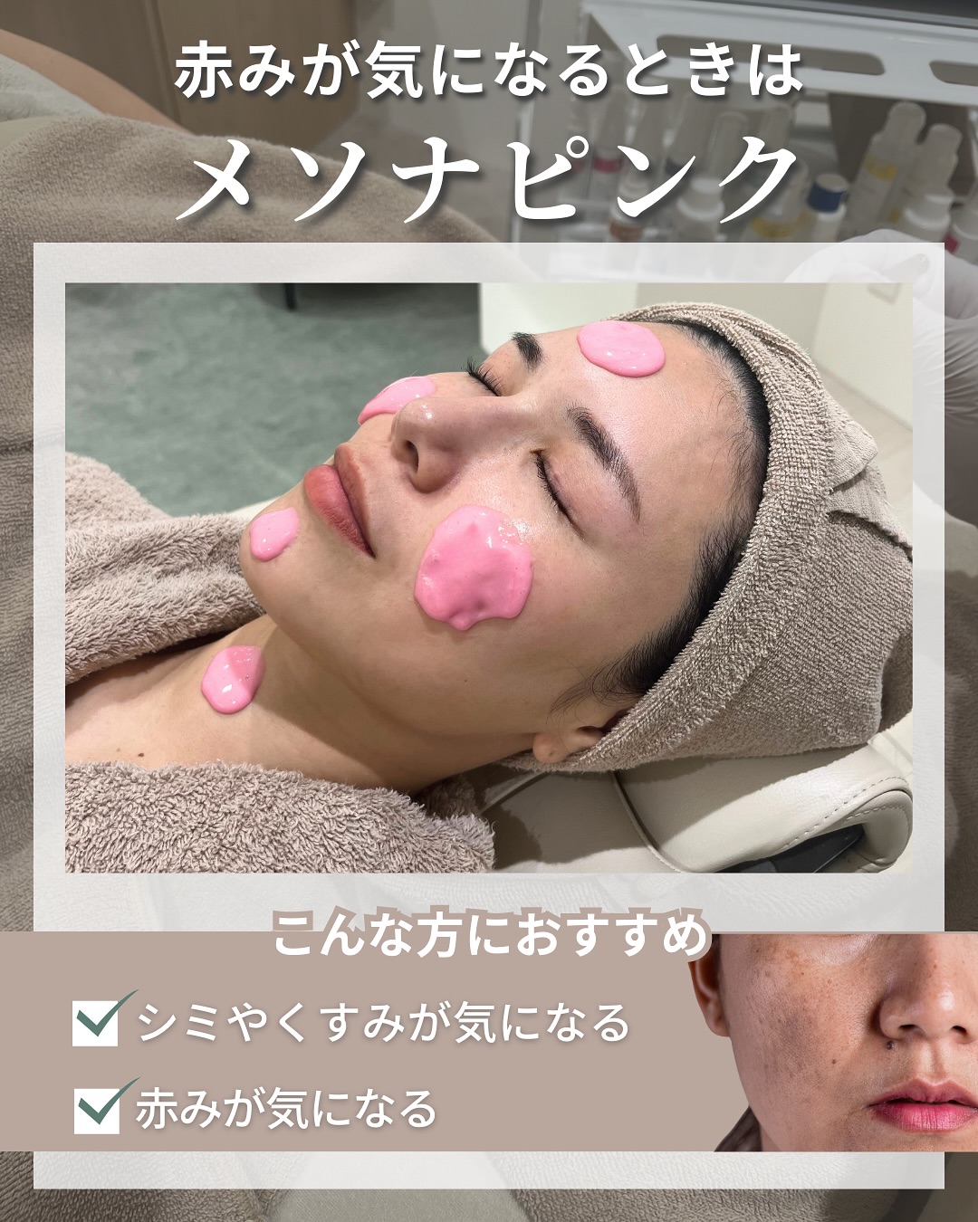 赤みが気になるときはメソナピンク