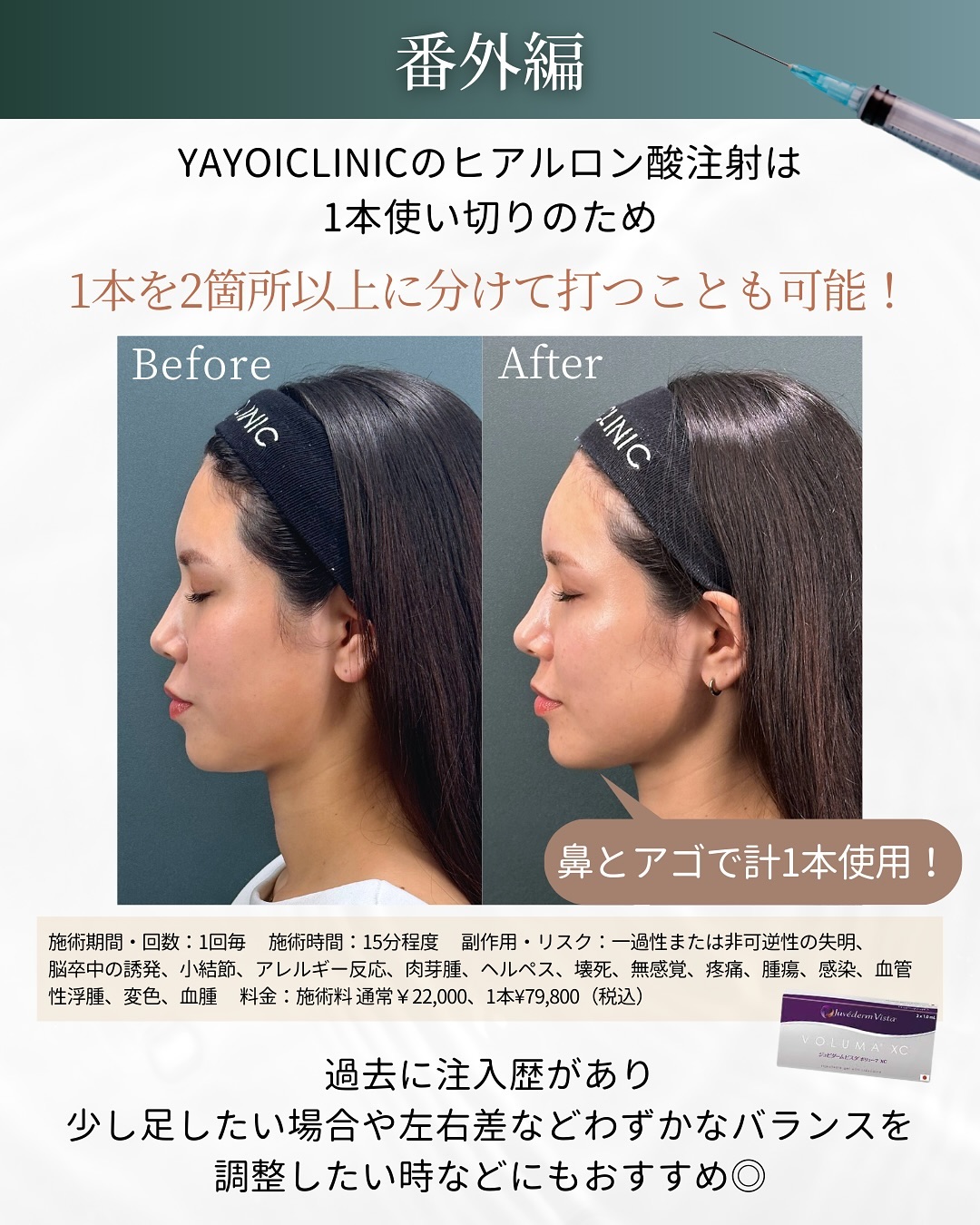 ヤヨイクリニックのヒアルロン酸注入