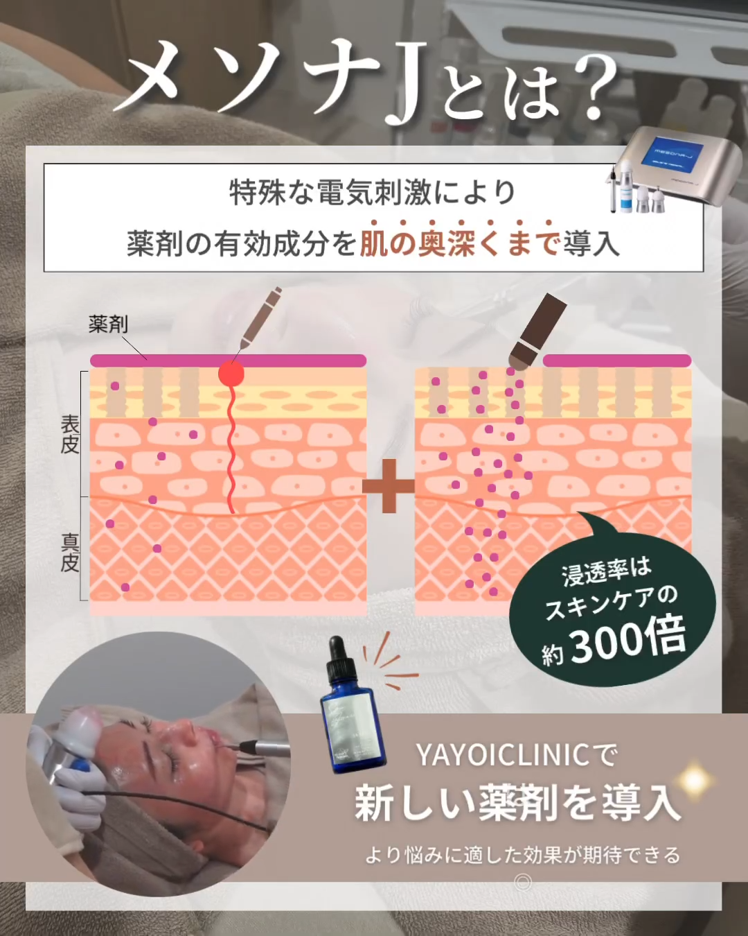 メソナJとは