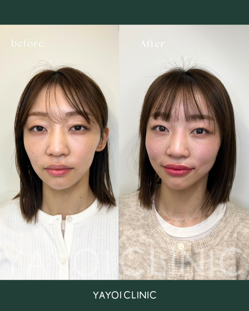 アートメイク（リップ）