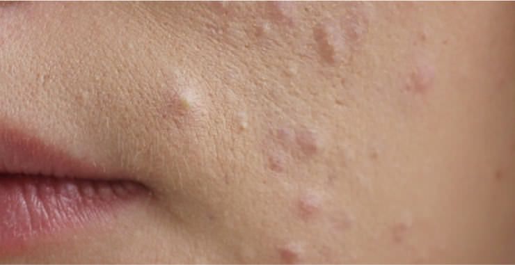 広島でニキビを治療|皮膚科で人気の治療は?ニキビの種類から施術の特徴まで